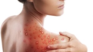 Como e o diagnostico e a definicao de caso de Monkeypox em pacientes site