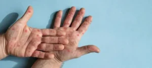 mpox 2389975 article