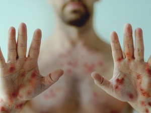 variola dos macacos monkeypox