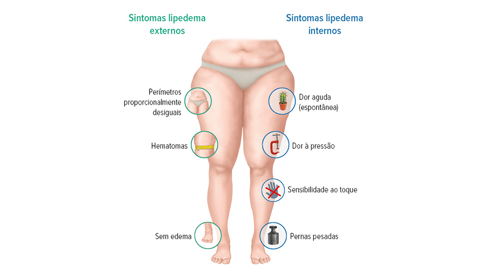 grafik ly symptome lipoedem web 650x650 prt
